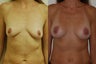 Breast Augmentation and Lift