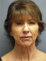 LiteLift™, Platysmaplasty, Blue Peel® on 62-year-old Woman