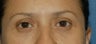 Mild upper lid excess skin, lower lid fat prolapse