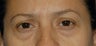 Mild upper lid excess skin, lower lid fat prolapse