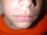 Male Pit Bull Attack Facial Reconstruction on Child