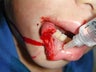 Male Pit Bull Attack Facial Reconstruction on Child