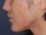 Before & After Photodynamic Therapy