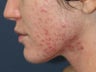Before & After Photodynamic Therapy