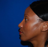 Rhinoplasty
