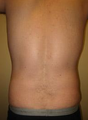 Smart Lipo