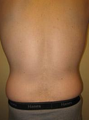 Smart Lipo