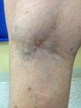 75 year old female with unusual small saphenous vein aneurysm