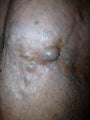 75 year old female with unusual small saphenous vein aneurysm