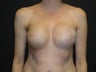 Breast reconstruction - Implants