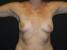 Breast reconstruction - Implants