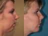 Chin Augmentation