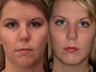 Chin Augmentation