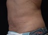 Coolsculpting