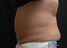 Coolsculpting