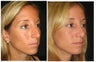 Rhinoplasty