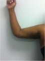 Laser Liposuction