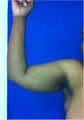 Laser Liposuction
