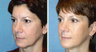 Endoscopic Midface Lift