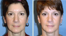 Endoscopic Midface Lift