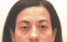 48 Year Old woman treated for forehead lines