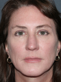 Before and After Fraxel Laser Treatment