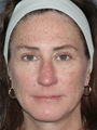 Before and After Fraxel Laser Treatment