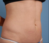 truSculpt