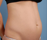 truSculpt