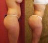 Buttock Augmentation or Brazilian Butt Lift- BBL