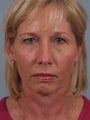 Heavy Upper Eyelids