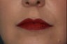 Female Lip Augmentation