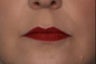 Female Lip Augmentation