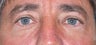 52 Year Old Male Treated For Lower Eyelid Bags