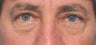 52 Year Old Male Treated For Lower Eyelid Bags