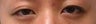 Bilateral Asian Eyelid Surgery