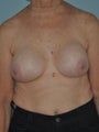 Breast lift with intense capsule removal and implant exchange for old implants
