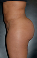 Brazilian Butt Lift