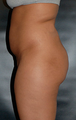 Brazilian Butt Lift