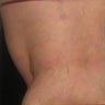 Spider Vein Sclerotherapy Results After Several Sessions