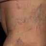 Spider Vein Sclerotherapy Results After Several Sessions