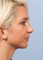 Woman treated for weak chin