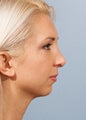 Woman treated for weak chin
