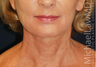 Lower Face Lift