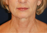 Lower Face Lift