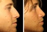 22 year-old male with a nose he feels is “too big” in proportion to the rest of his facial features.