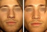 22 year-old male with a nose he feels is “too big” in proportion to the rest of his facial features.