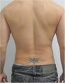 Laser Lipo
