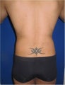 Laser Lipo