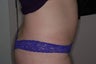 CoolSculpting Treatment of Abdomen